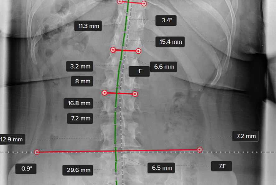 Chiropractic Digital Xray Measurement Tools